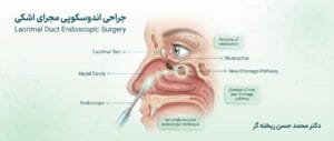 جراحی اندوسکوپی مجرای اشکی