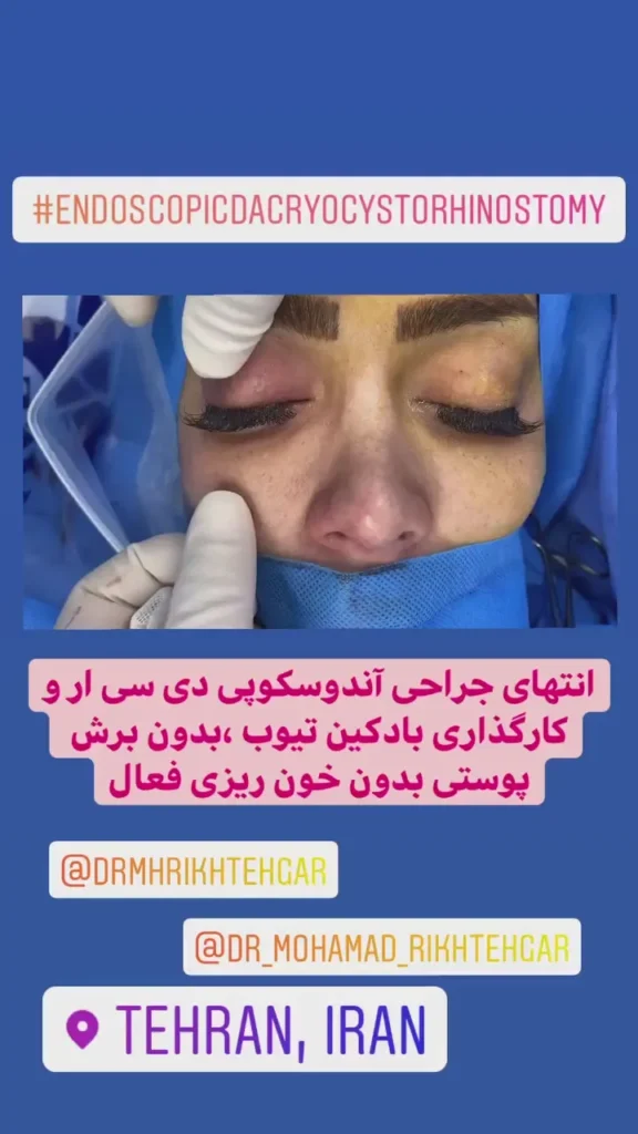 انسداد مجرای اشکی: 8 مراقبت قبل و بعد جراحی DCR