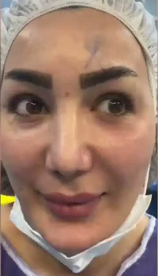 جراحی اندوسکوپی مجرای اشکی (Endoscopic DCR) | راهنمای جامع 2025