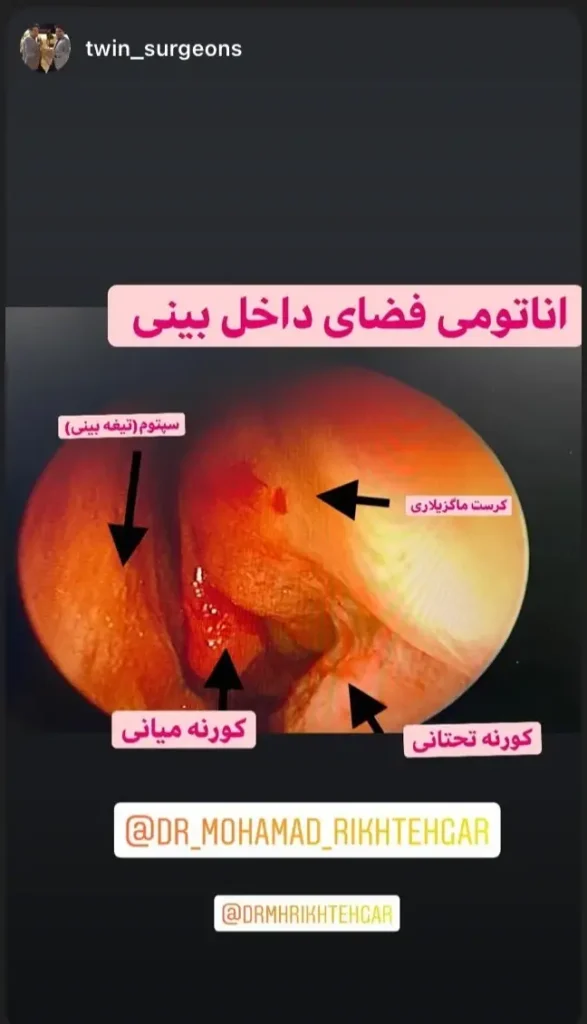 جراحی اندوسکوپی مجرای اشکی: چرا اصلاح تیغه بینی لازم است؟