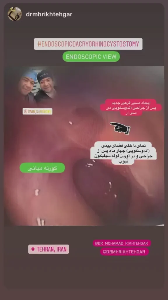 داكریوسیستورینوستومی خارجی یا اندوسکوپیک؟ مزایا و معایب