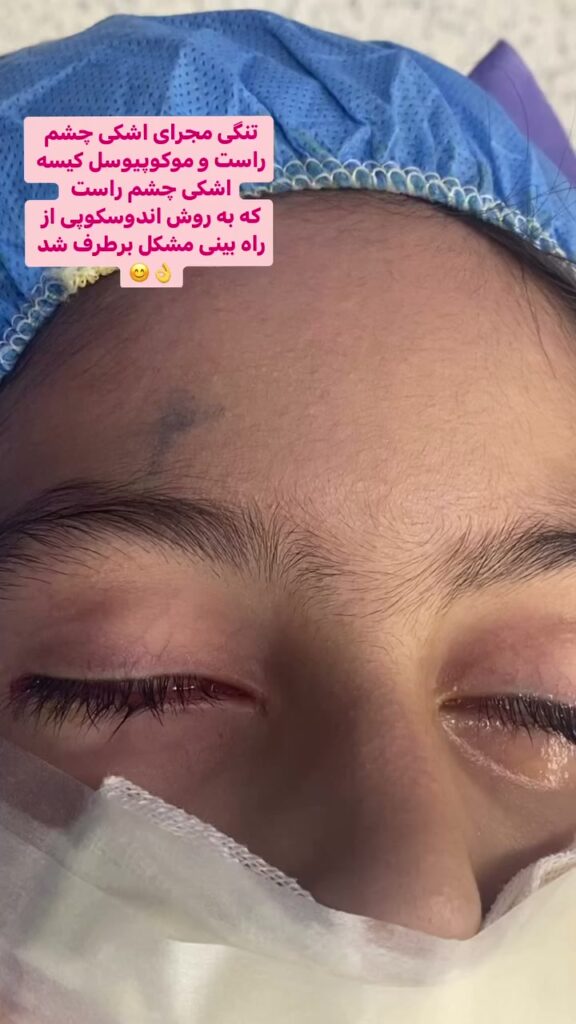 جراحی اندوسکوپی مجرای اشکی بدون برش پوستی