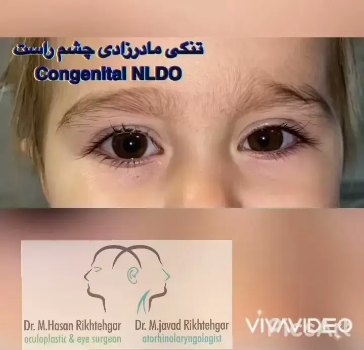 جراحی اندوسکوپی مجرای اشکی (Endoscopic DCR) | راهنمای جامع 2025