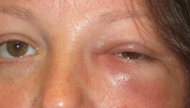 عفونت مزمن کیسه اشکی: جراحی اندوسکوپی ایمن و مرحله‌به‌مرحله