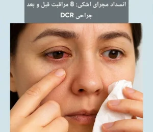 انسداد مجرای اشکی: 8 مراقبت قبل و بعد جراحی DCR