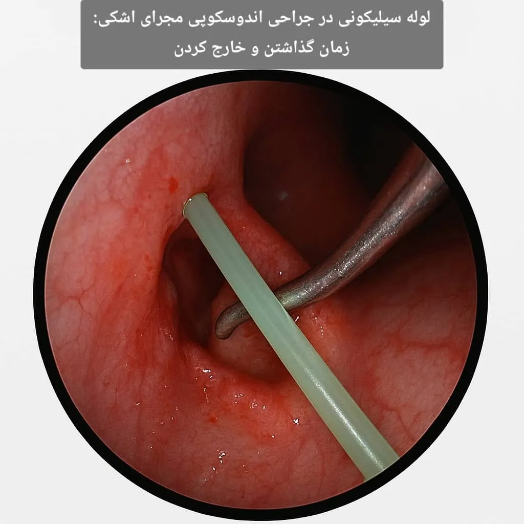 لوله سیلیکونی در جراحی اندوسکوپی مجرای اشکی: زمان گذاشتن و خارج کردن