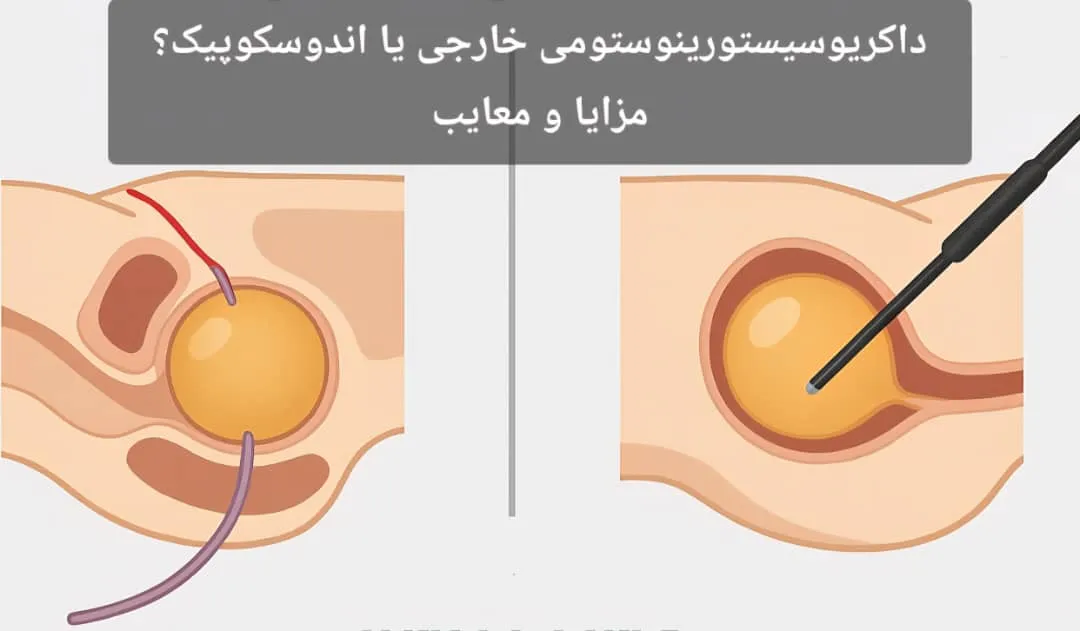 داكریوسیستورینوستومی خارجی یا اندوسکوپیک؟ مزایا و معایب