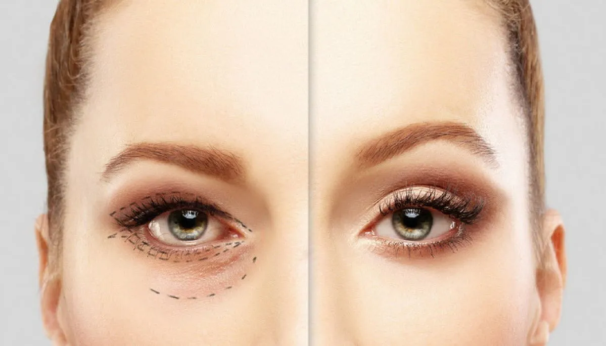 بلفاروپلاستی چیست و چگونه انجام می‌شود؟ | راهنمای جامع 2025