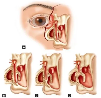 تصویربرداری قبل از جراحی مجرای اشکی؛ چرا حیاتی است؟