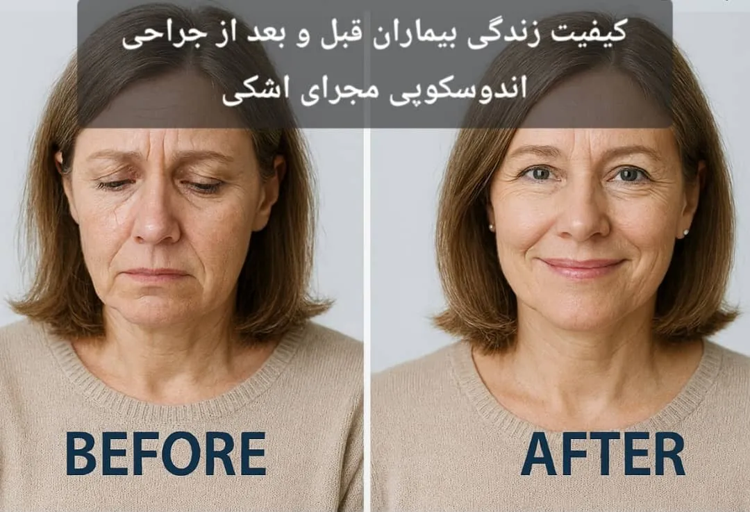 کیفیت زندگی بیماران قبل و بعد از جراحی اندوسکوپی مجرای اشکی