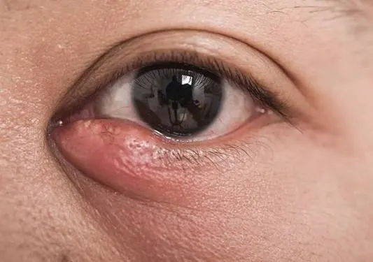 ریزش اشک، سوزش و عفونت گوشه چشم: شایع اما نیازمند تشخیص دقیق