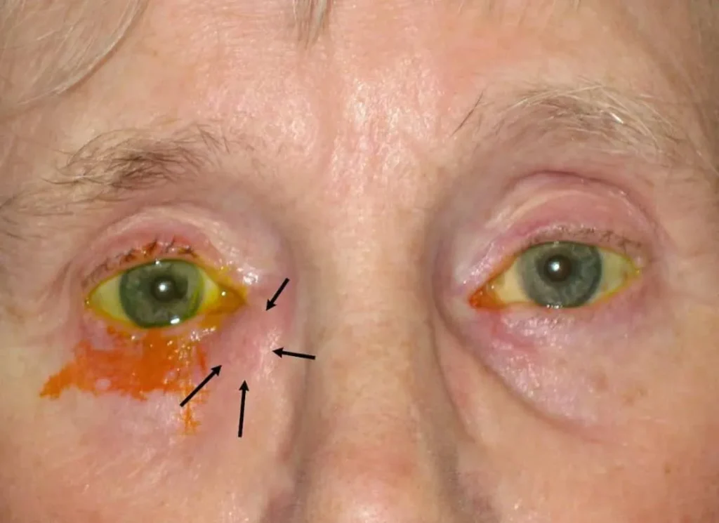 جراحی اندوسکوپی مجرای اشکی با بیحسی موضعی