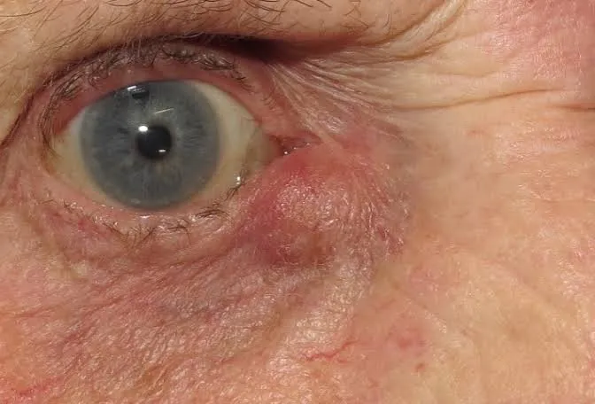 جراحی اندوسکوپی مجرای اشکی در بیماران پرخطر و دارای اختلالات انعقادی