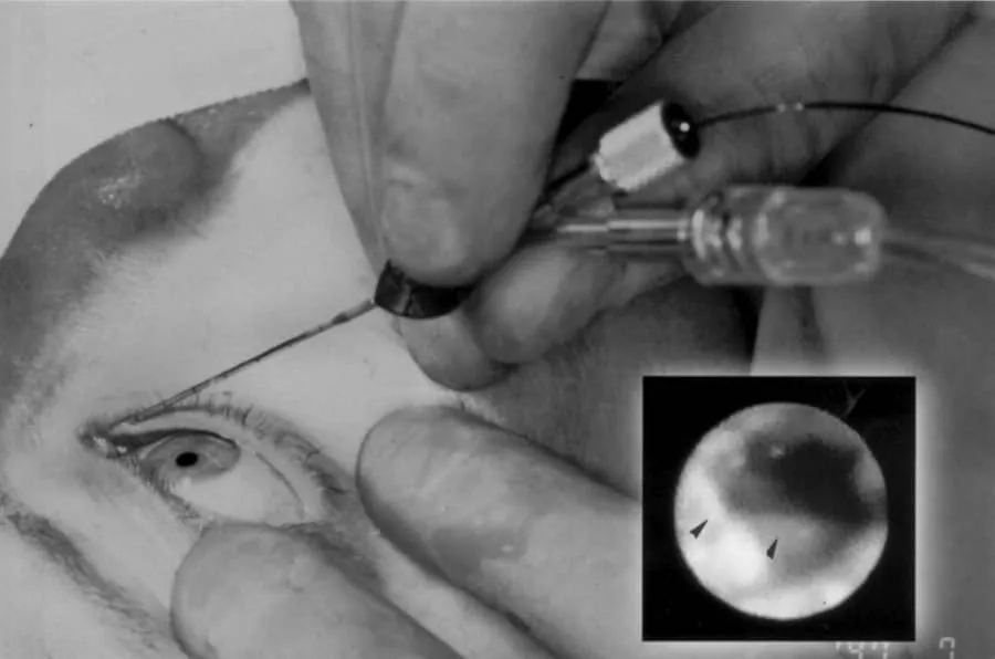 عود ریزش اشک پس از DCR اندوسکوپیک: علل و پیشگیری