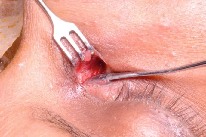 پرسش‌های متداول بیماران درباره جراحی اندوسکوپی مجرای اشکی