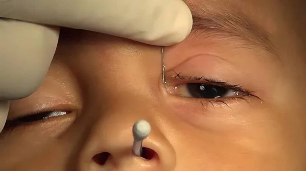 کیفیت زندگی بیماران قبل و بعد از جراحی اندوسکوپی مجرای اشکی