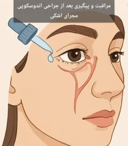 مراقبت و پیگیری بعد از جراحی اندوسکوپی مجرای اشکی