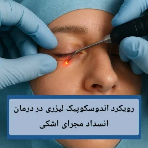 رویکرد اندوسکوپیک لیزری در درمان انسداد مجرای اشکی