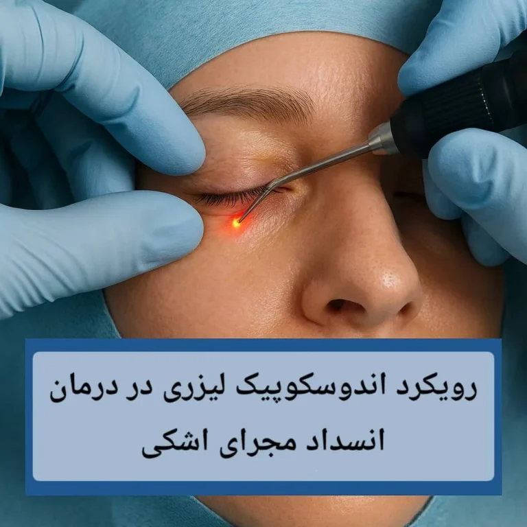 رویکرد اندوسکوپیک لیزری در درمان انسداد مجرای اشکی