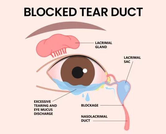 عود ریزش اشک پس از DCR اندوسکوپیک: علل و پیشگیری