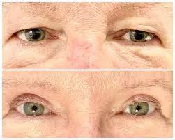 مراقبت و پیگیری بعد از جراحی اندوسکوپی مجرای اشکی