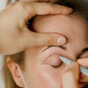 مراقبتهای بعد از بلفاروپلاستی برای بهترین نتیجه