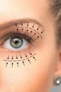 عوارض بلفاروپلاستی؛ حقایق و باورهای غلط