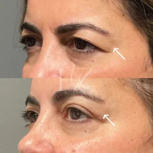 بلفاروپلاستی پلک بالا و پایین؛ کدام را عمل کنیم؟