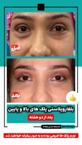 نتیجه بلفاروپلاستی