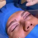 آیا بلفاروپلاستی درد دارد؟ بررسی علمی + تجربه بیماران