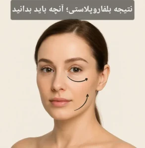 نتیجه بلفاروپلاستی؛ آنچه باید بدانید