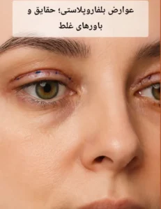 عوارض بلفاروپلاستی؛ حقایق و باورهای غلط