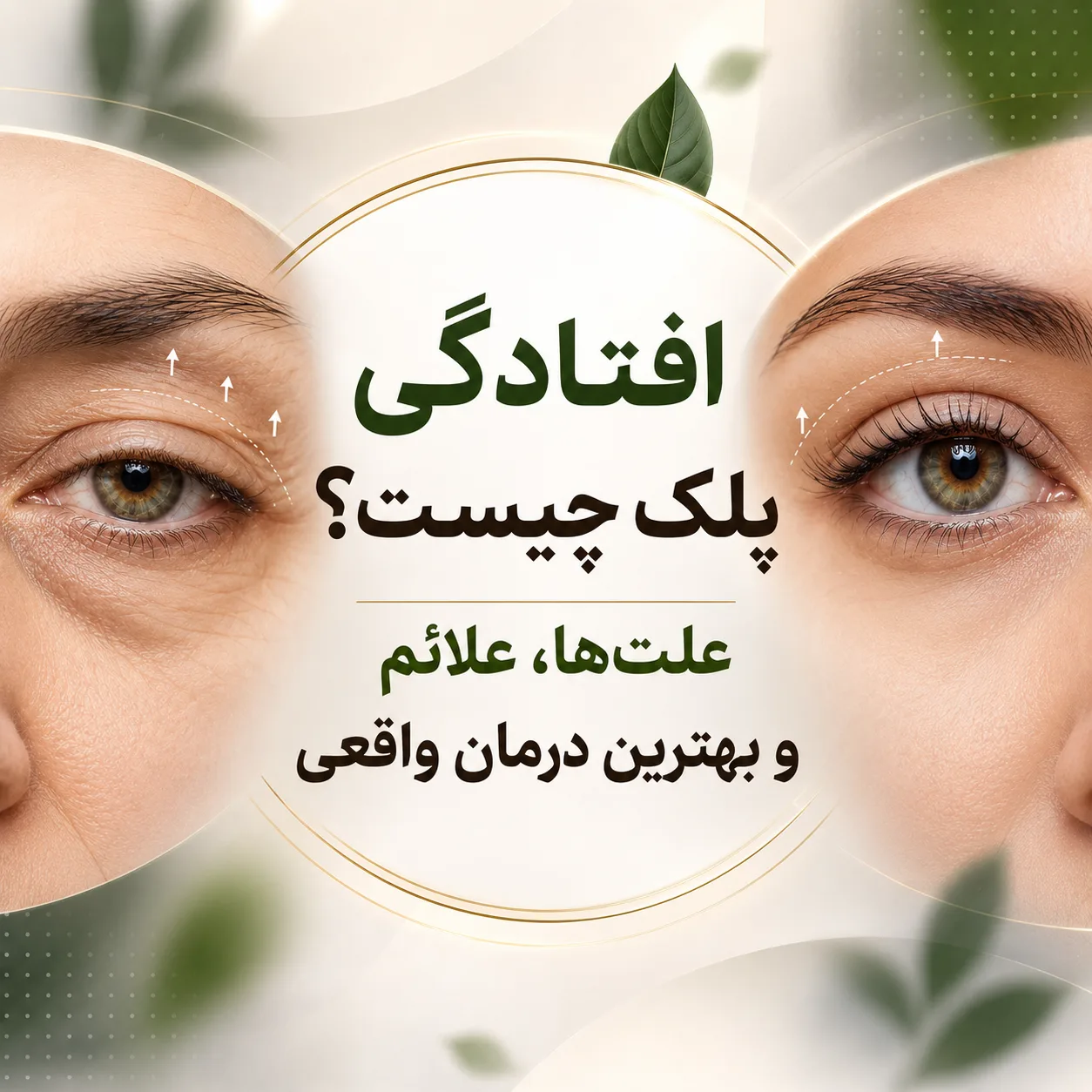 افتادگی پلک دقیقاً چیست؟