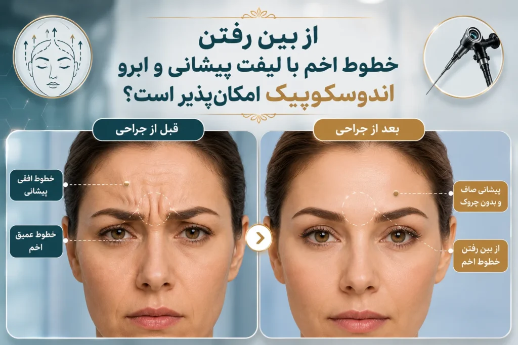 از بین رفتن خطوط اخم