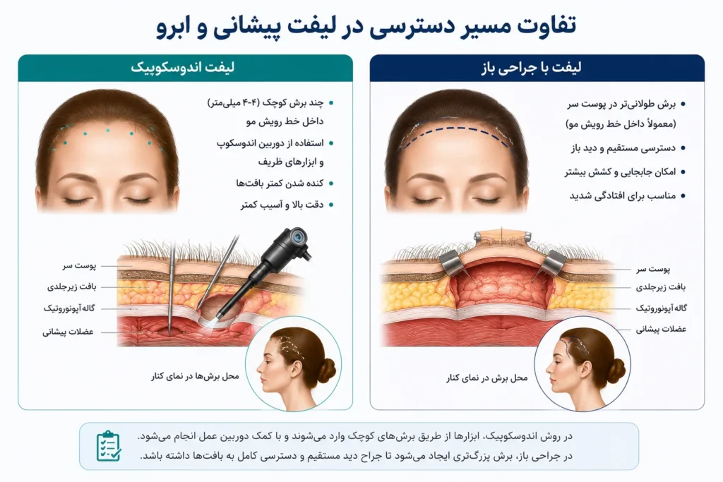 مقایسه لیفت پیشانی و ابرو اندوسکوپیک و جراحی باز