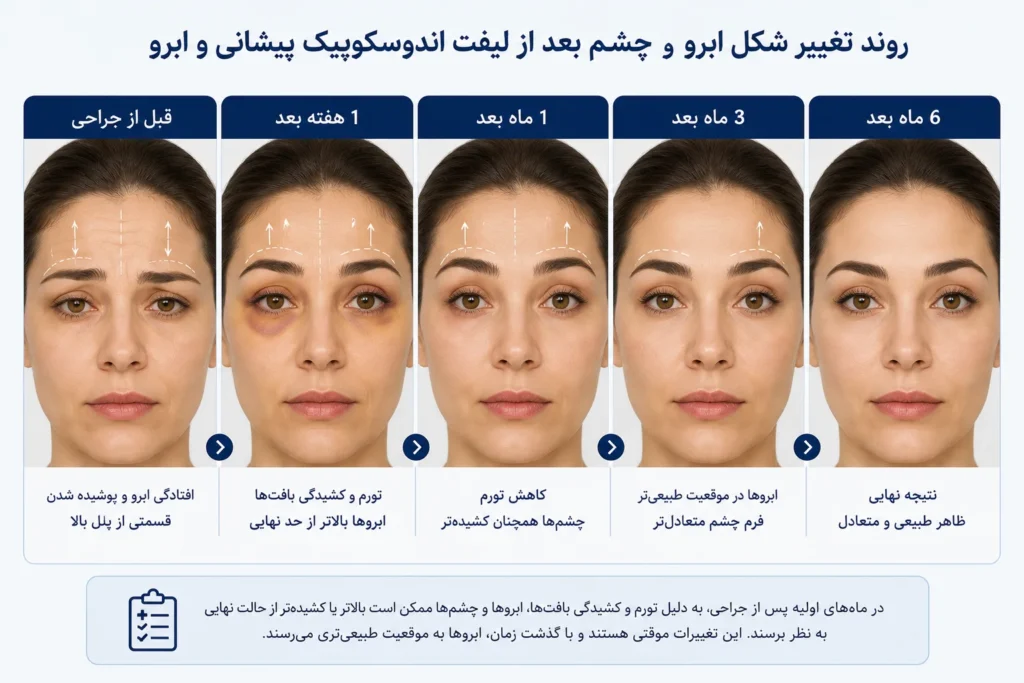 تغییر حالت چشم بعد از لیفت پیشانی و ابرو اندوسکوپیک طبیعی است؟