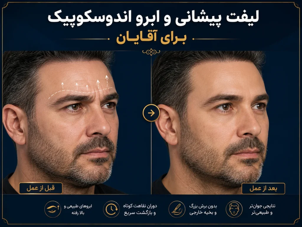 لیفت پیشانی و ابرو اندوسکوپیک برای آقایان
