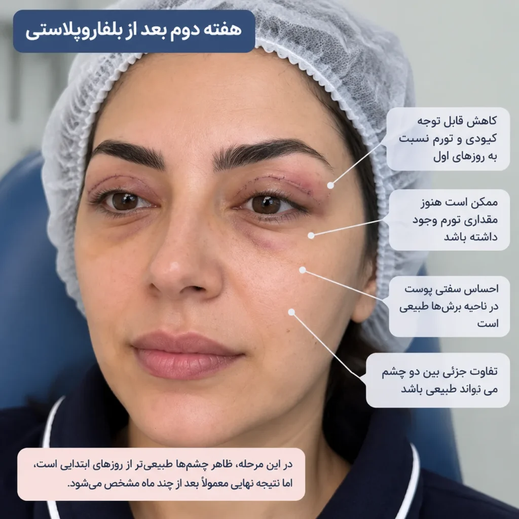 هفته دوم بعد از بلفاروپلاستی چه تغییراتی ایجاد می‌شود؟